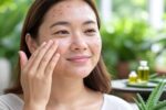 Natural Remedies for Acne Scars
